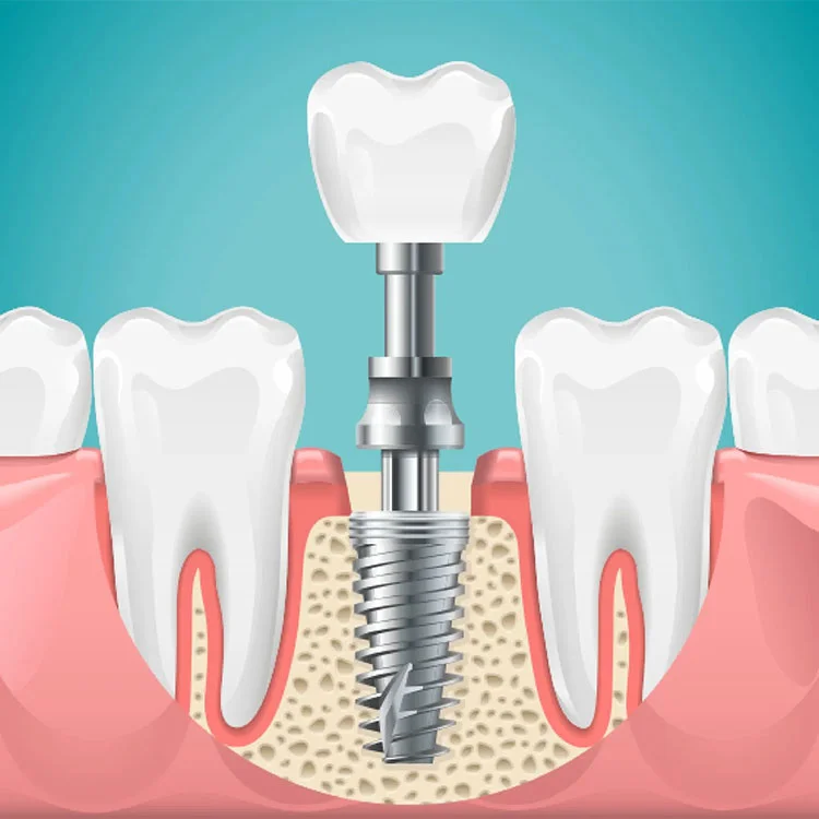 Dental Implant
